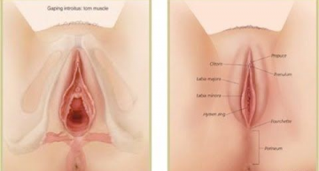 Loose Vagina: Can It Be Tighten Again?