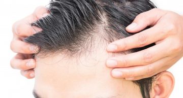 Major reasons for baldness in men and methods to deal with it