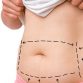 5 Tips How To Maintain The Results From The Liposuction Procedures