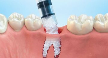 The Procedure and Precautions of Dental Implantation and Bone Grafting