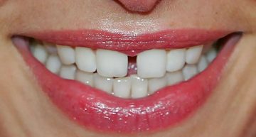 Clear Retainers: 6 Things You Should Know