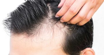 What are The Hair Loss ProductsAvailable?