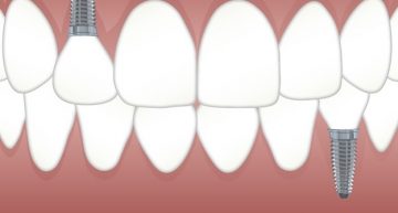 How Much Do Dental Implant Cost?