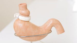 Myths About Lap-Band Surgery