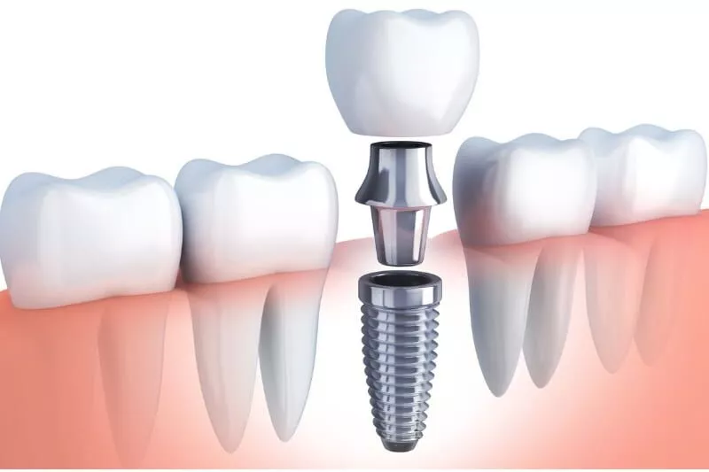 Dental Implants in Michigan and AfterCare