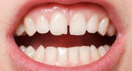 Whiten Your Teeth With Top Home Remedies