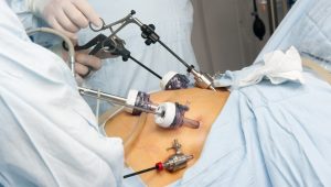 Gastric Bypass