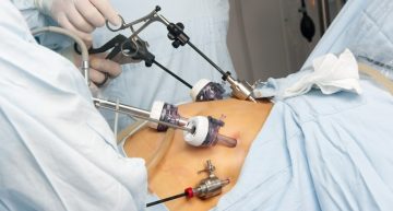 Understanding the Role of Gastric Bypass in the Battle Against Morbid Obesity