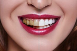 Tooth Discoloration