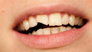 chipped teeth